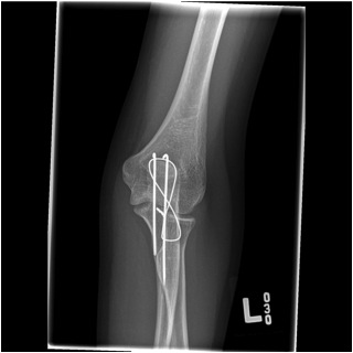 Olecranon Fracture AP TBW